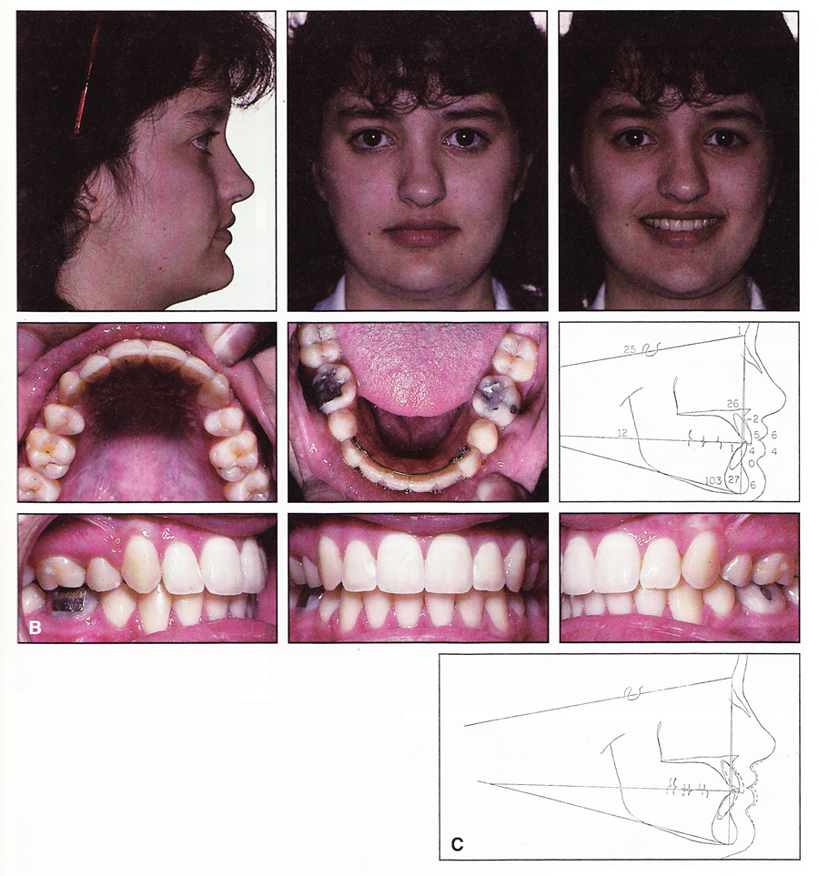 Where Teeth Should Be Positioned in the Face and Jaws and How To Get