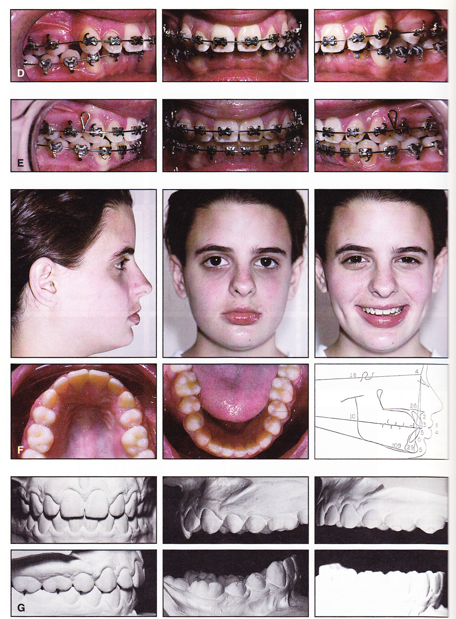 Where Teeth Should Be Positioned in the Face and Jaws and How To Get