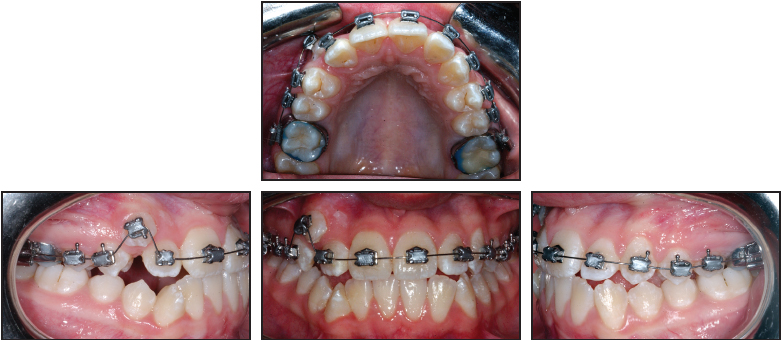How Nickel, Copper, and Cobalt are Changing Braces - Massih Orthodontics