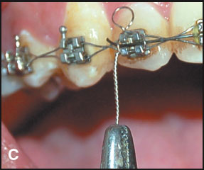 AZDENT Preformed Kobayashi Ligature Ties - Orthodontic Stainless Steel Wires