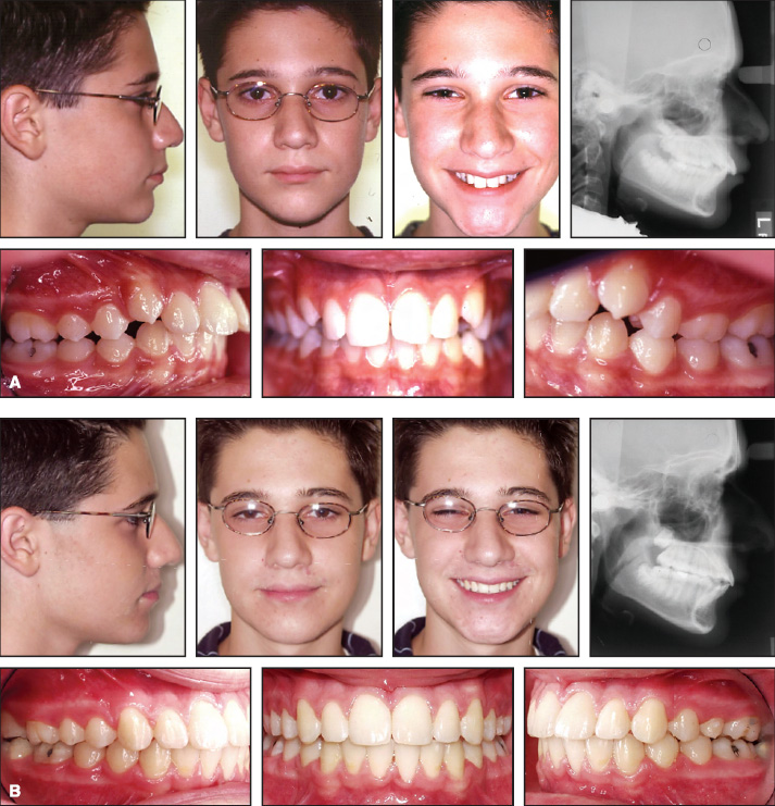 Stability of a severe Class II malocclusion correction in a