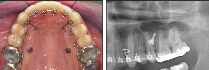 OVERVIEW Anatomical Guidelines for Miniscrew Insertion: Palatal Sites