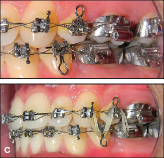 JCO Pearl: Stiff Hook for Elastics Attachment