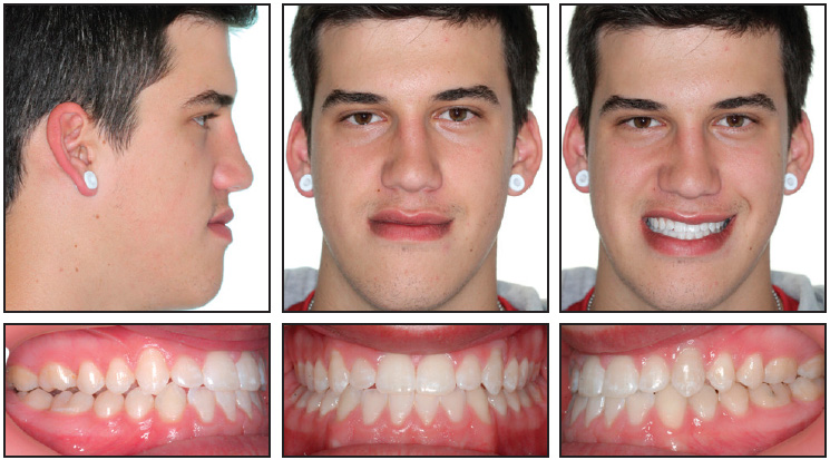 Nonsurgical Correction of Severe Skeletal Class III ...