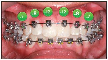 Braces Wire Size Chart