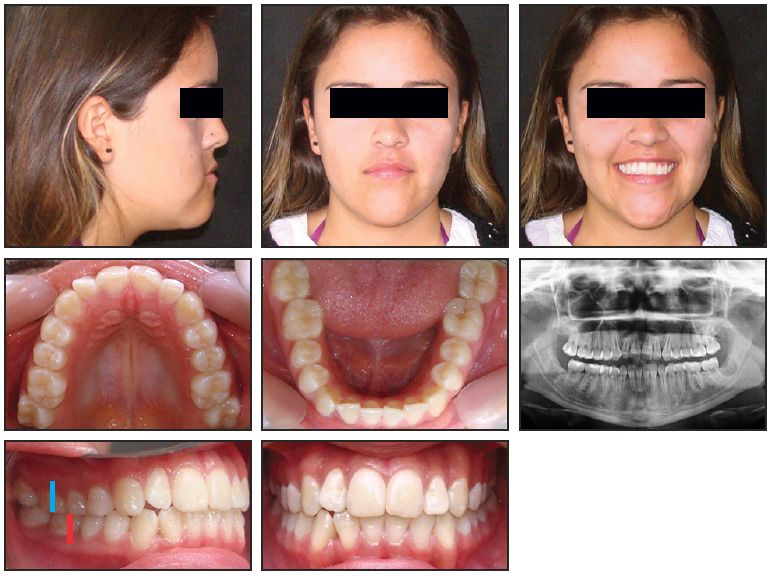 Hidden Braces Behind Teeth  The Orthospaceship- Hakim Orthodontics
