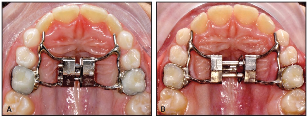 The nickel-titanium (NiTi) palatal expander appliance: (a) NiTi