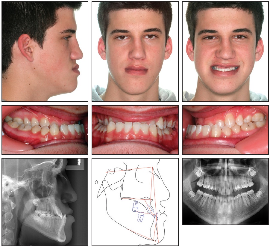 Carriere Class III Motion for Skeletal Class III