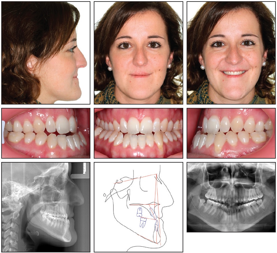 Carriere Class III Motion for Skeletal Class III