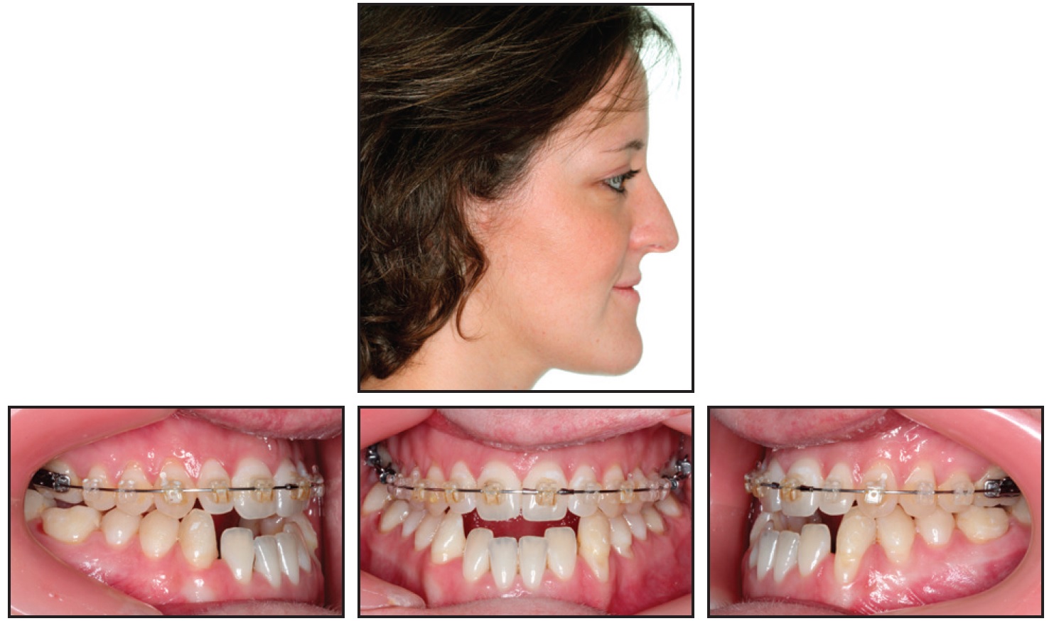 class i occlusion canine