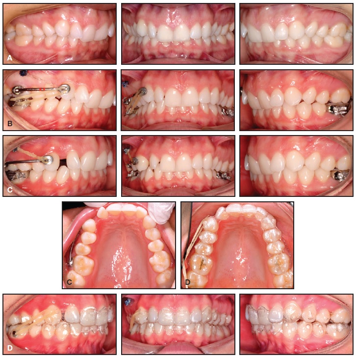 Intermaxillary Elastics with Clear Aligners: Types & Use