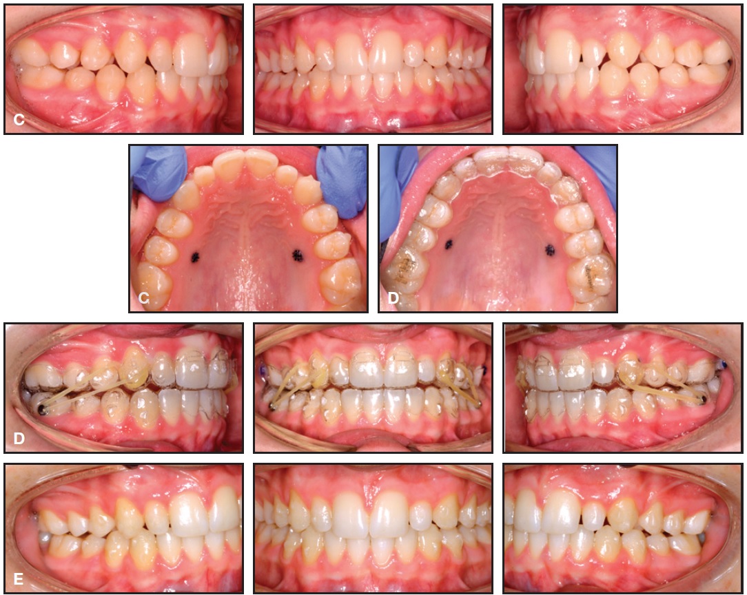 class ii elastics aligners