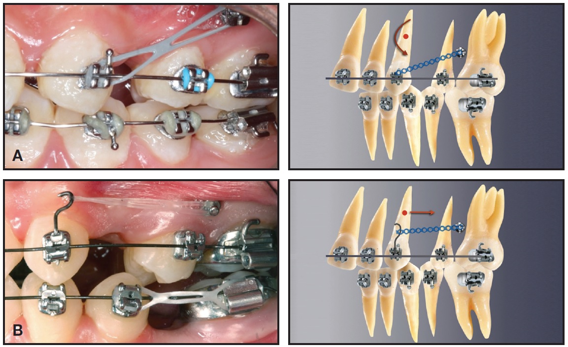 Overlay wires - Biomechanical Institute for Orthodontics