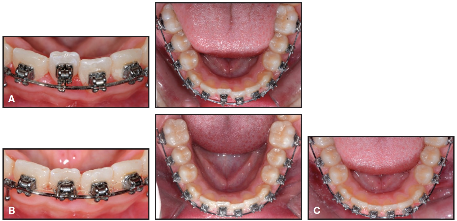 Uses Of The Vertical Slot In Orthodontic Brackets Jco Online