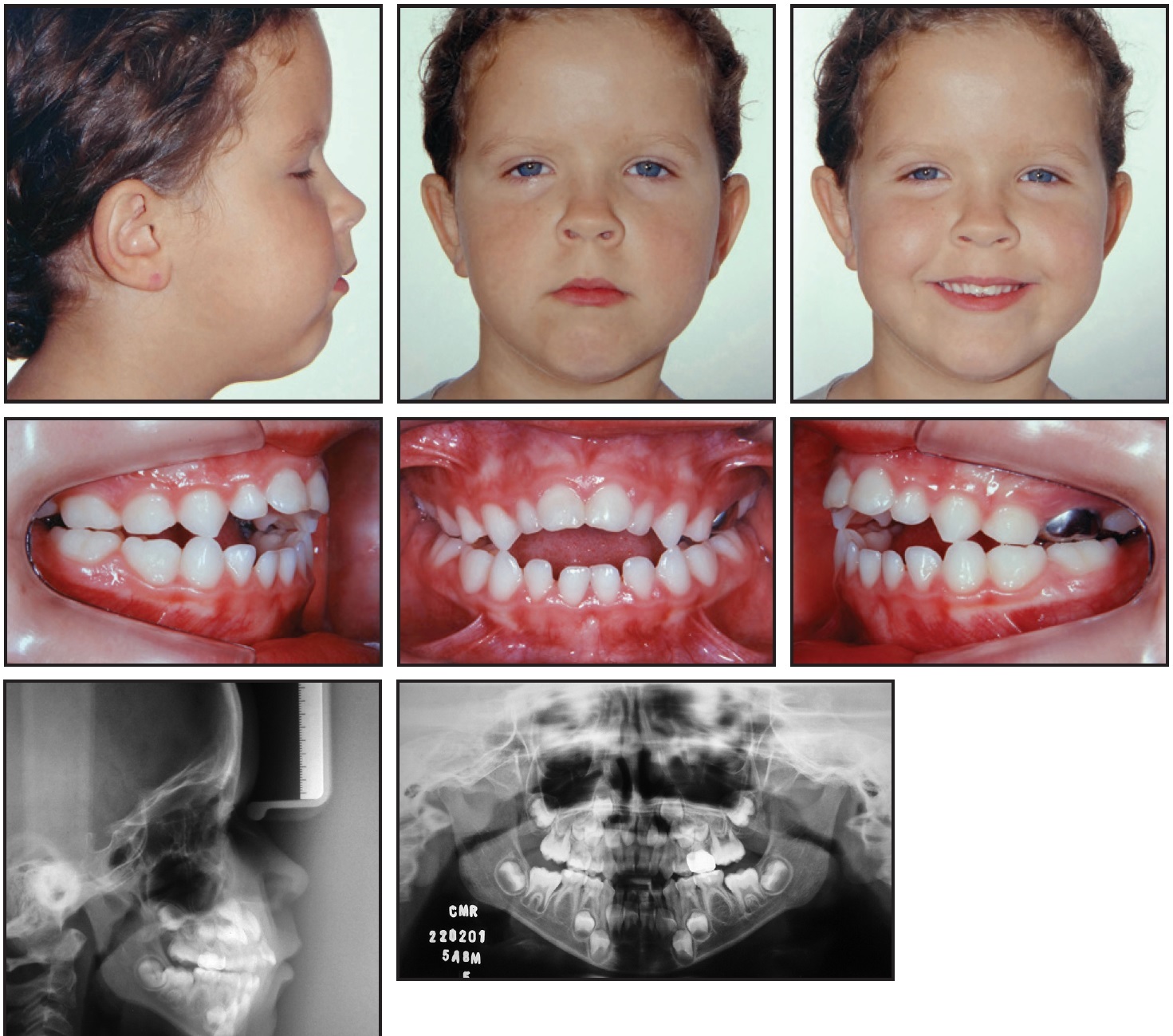 pacifier teeth in adults