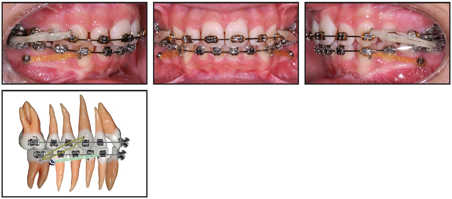 Interarch elastics are important to a successful orthodontic