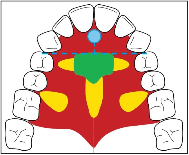 @齒顎矯正每日一說~~0228palatal miniscr