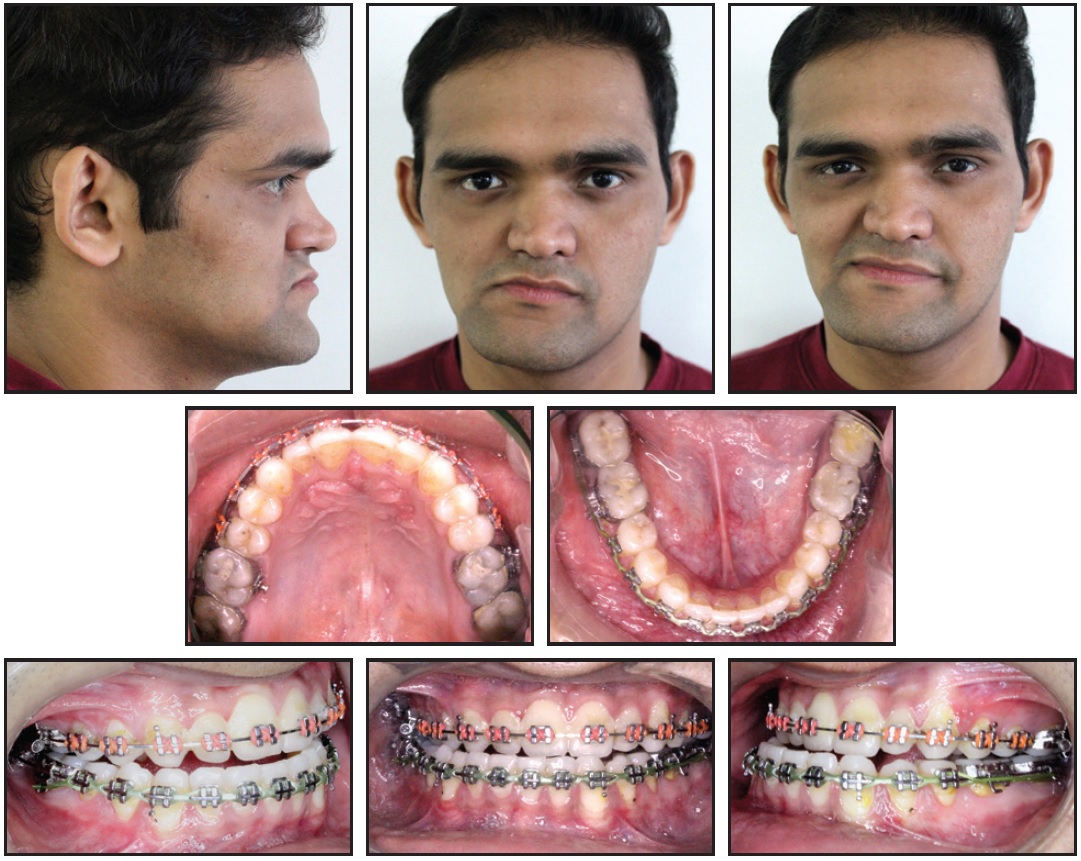 type 3 mandibular bone height