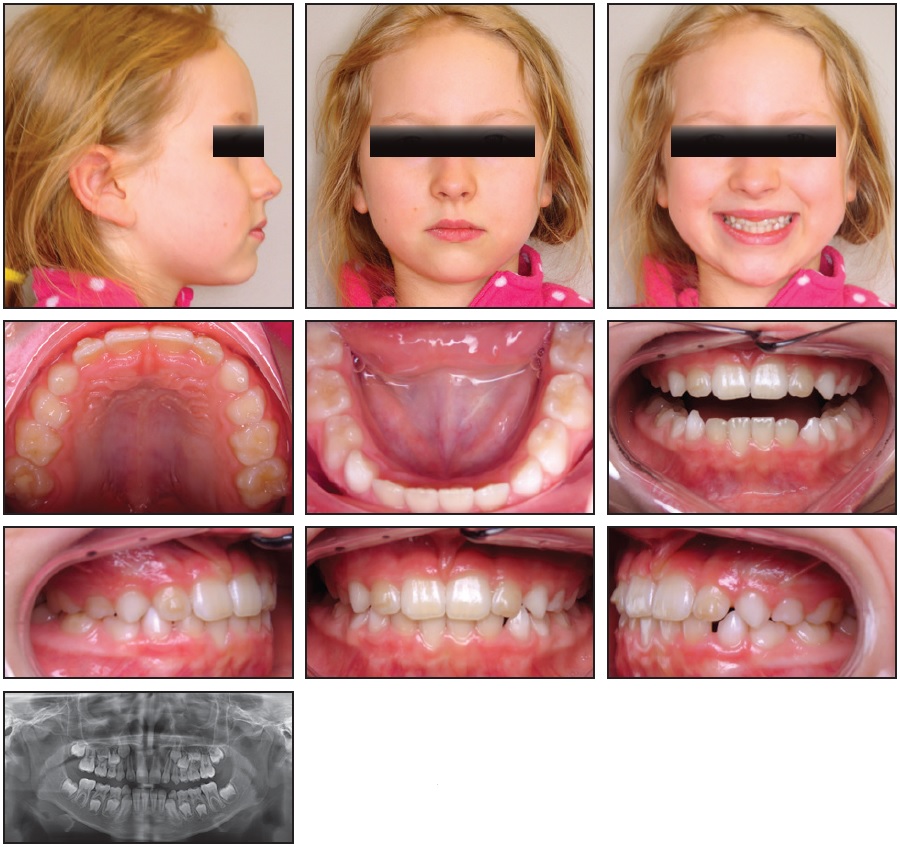 Aligner Treatment in Phase I