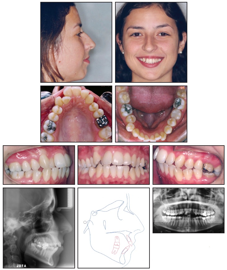 My ortho did not change wire for 6 months now. Is that normal? Also, do you  think I have crowded arch? : r/braces