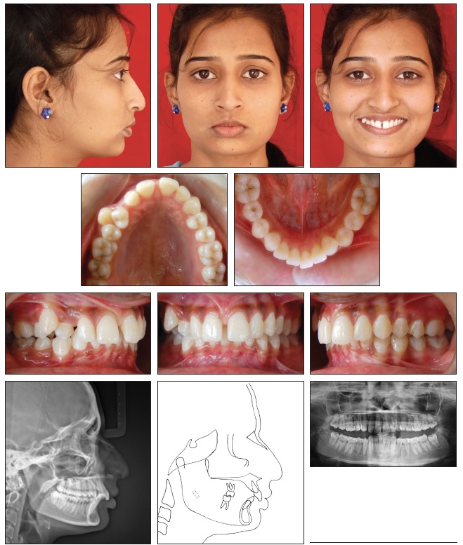 Unilateral Transposition Correction in Class II Case