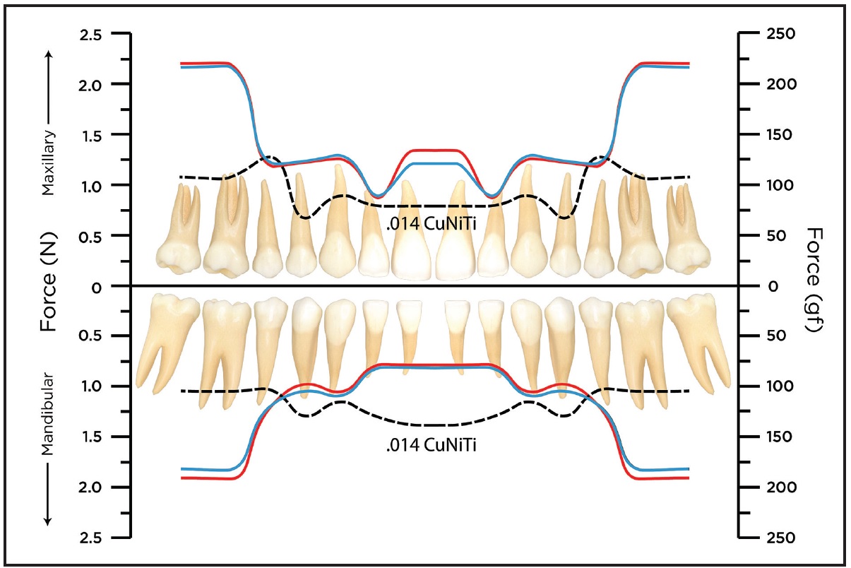 The Orthoevolution of Orthodontic Archwires
