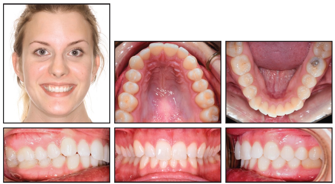 Overlay wires - Biomechanical Institute for Orthodontics