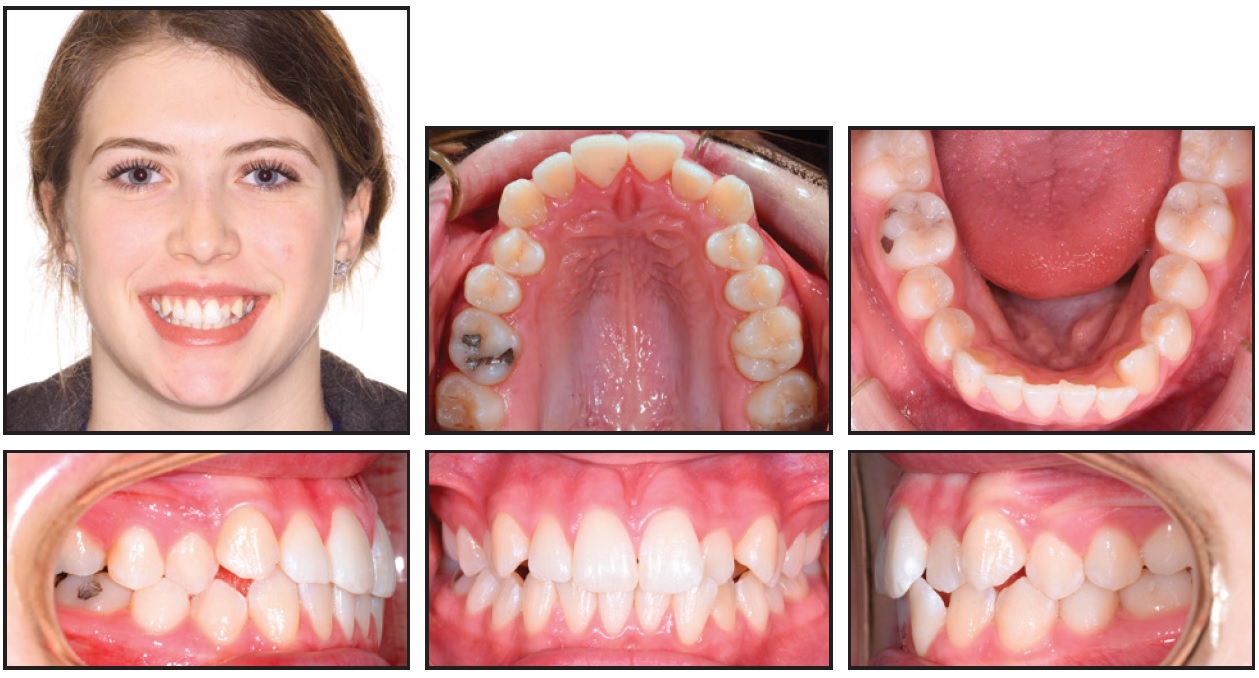 My ortho did not change wire for 6 months now. Is that normal? Also, do you  think I have crowded arch? : r/braces