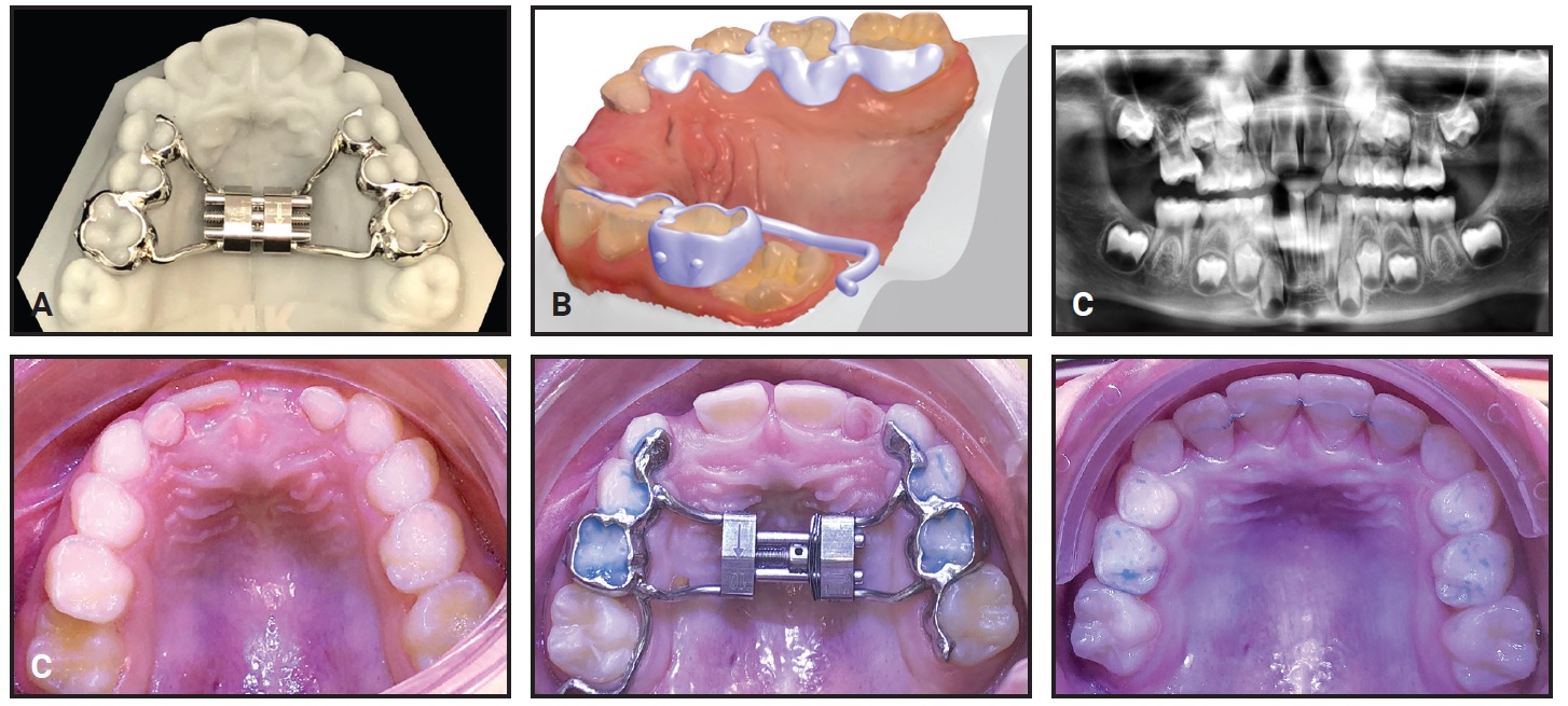 Rapid Palatal Expander - Sintered