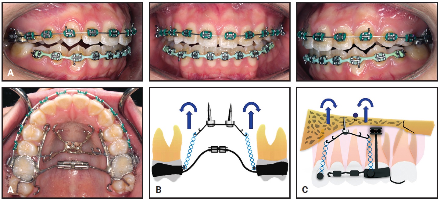 Managing Entire Maxillary Arch's Vertical Growth with TADs
