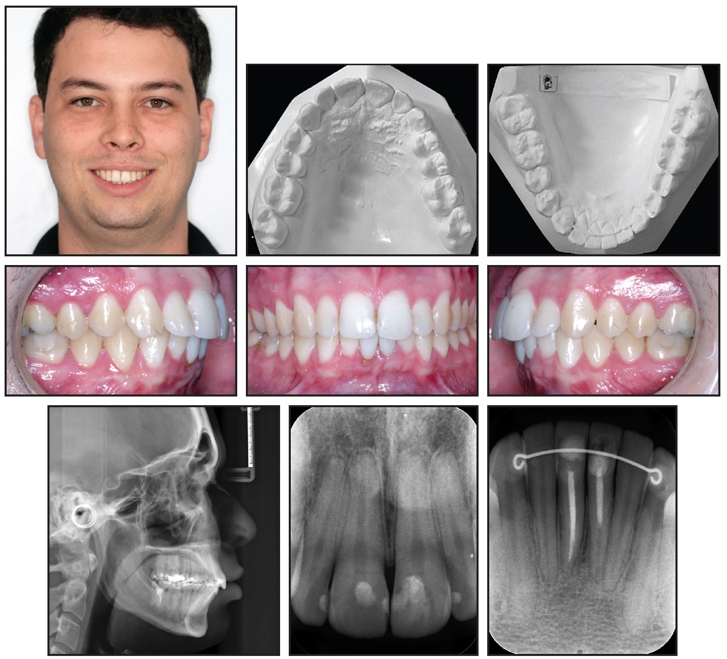 Self-Ligating Braces - Stoneham Malden MA