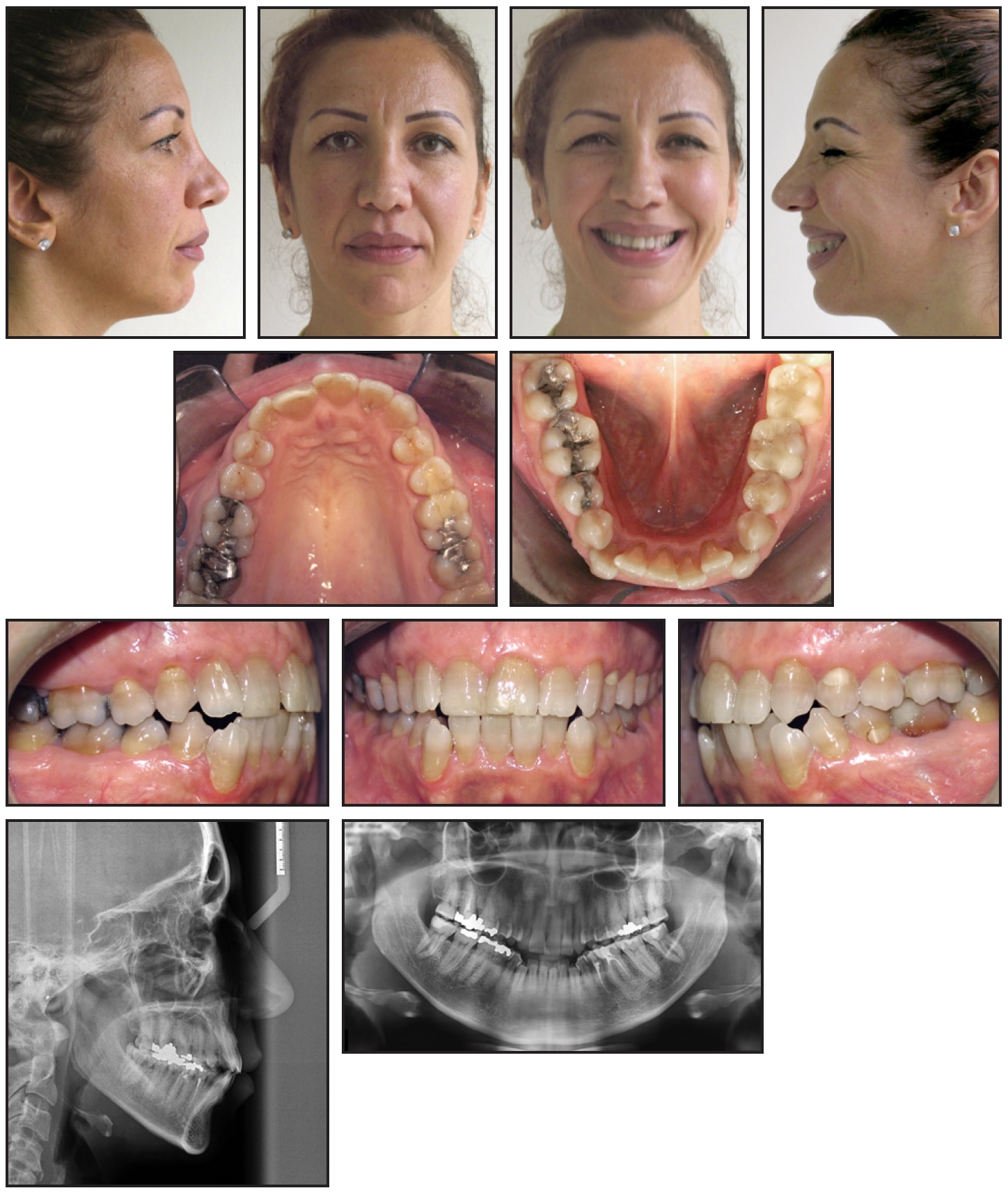 Canine sales teeth braces