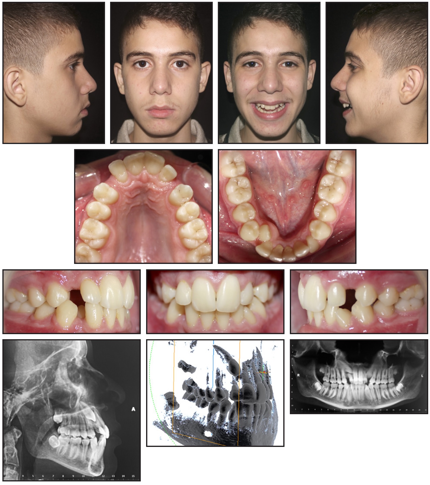 Canine sales teeth braces