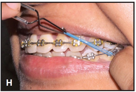 How to use Elastics - Orthodontic Appliances - Doctor Emma