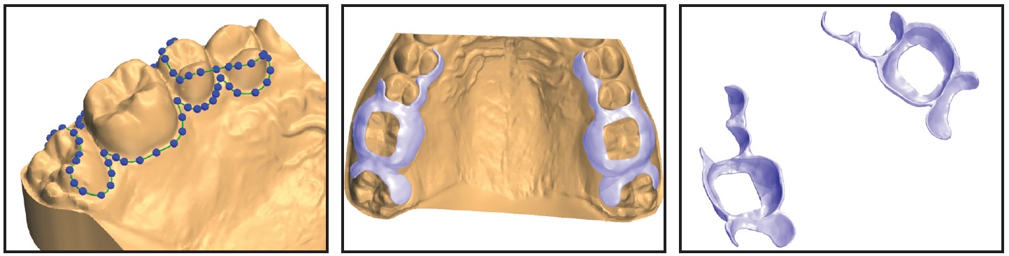 Laser Sintered RPE for Easier Placement and Removal