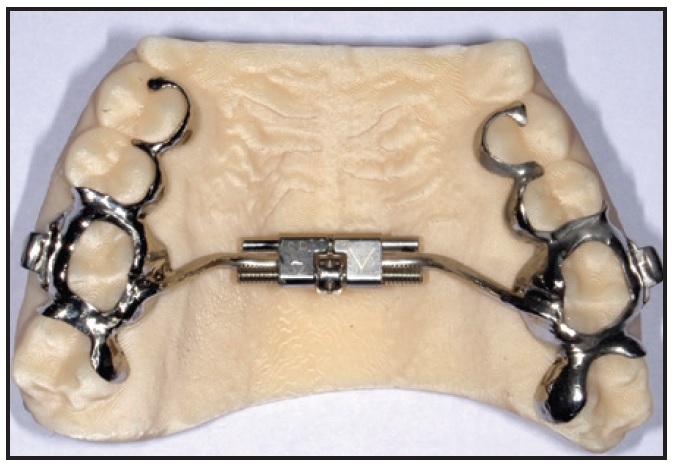 Rapid Palatal Expander - Sintered