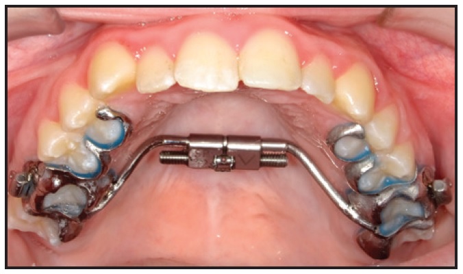 Tooth-borne (Hyrax ® ) Expander. 1 = Bands, 2 = Hyrax ® -screw