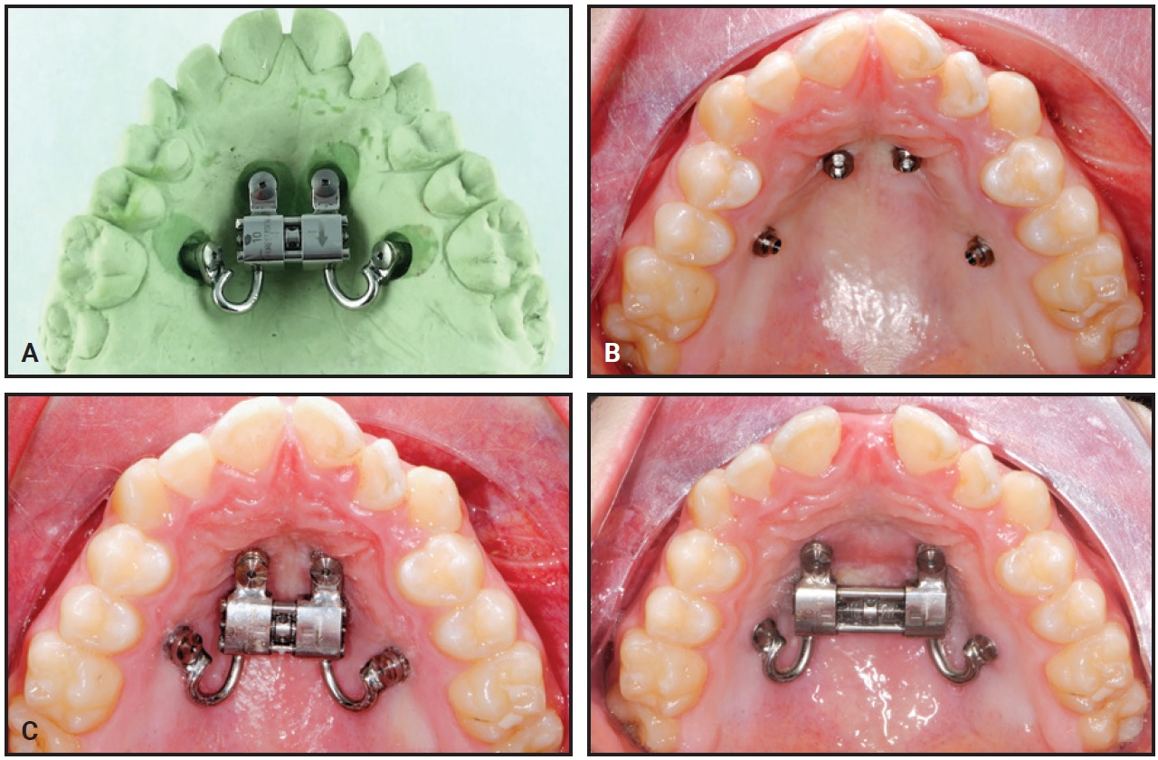 Bone First MARPEs with Insertion Guides