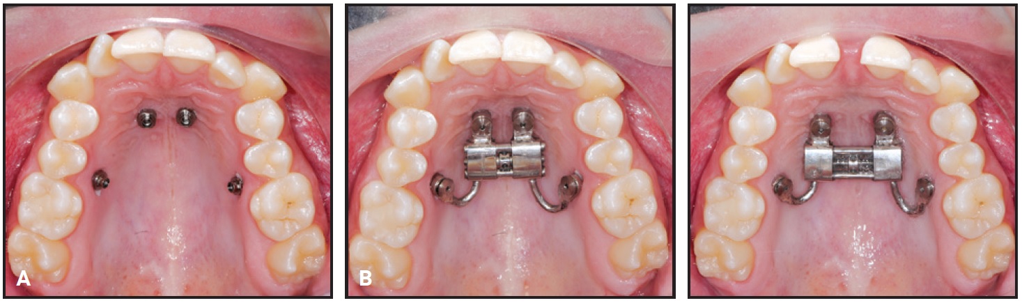 Bone First MARPEs with Insertion Guides