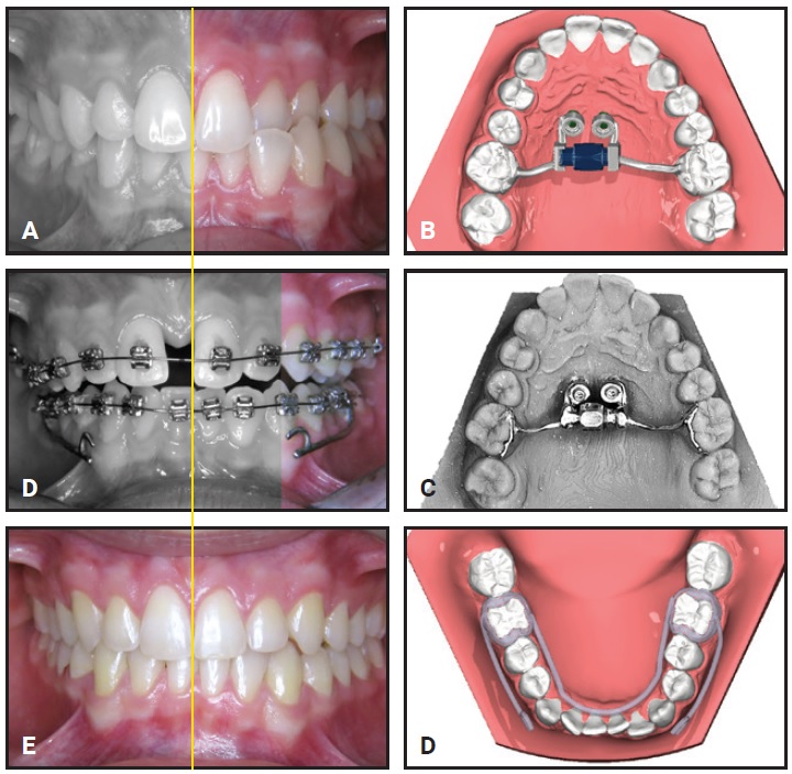 Palatal Expansion  ODL Orthodontic Labs