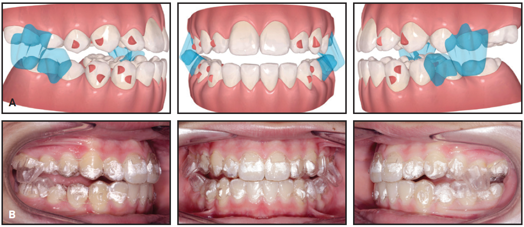 Timing Considerations for Mandibular Advancement with Aligners